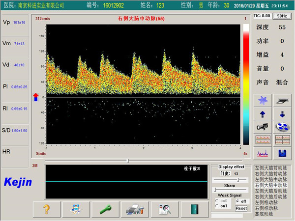 經(jīng)顱多普勒軟件PW模式下單窗口檢測界面.jpg