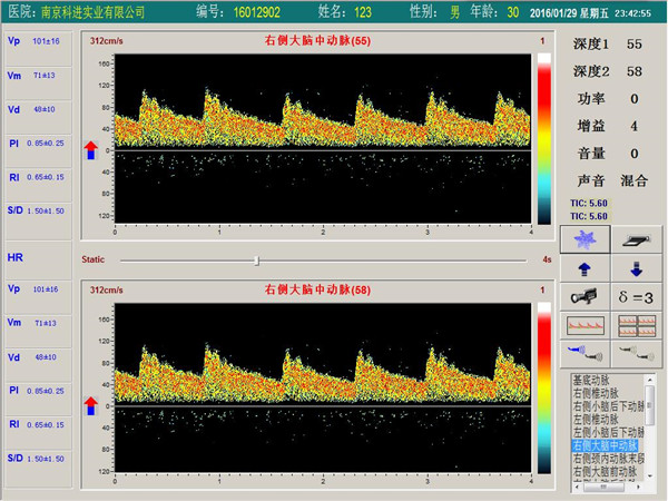 經(jīng)顱多普勒單通道，雙深度界面