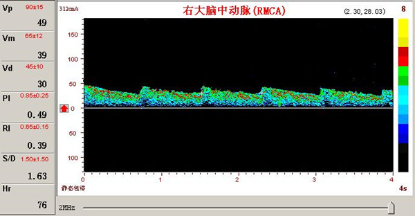 超聲經顱多普勒腦動脈瘤頻譜圖.jpg