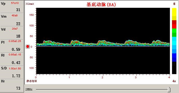 超聲經(jīng)顱多普勒基底動(dòng)脈供血不足頻譜圖.jpg