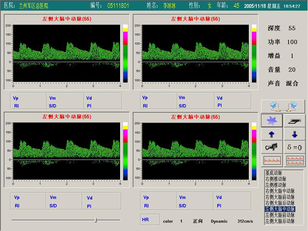 超聲經(jīng)顱多普勒血流分析儀四窗口（四深度）檢測界面.jpg