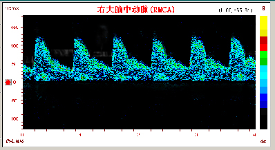 腦動(dòng)脈硬化的TCD表現(xiàn)和常見疾病